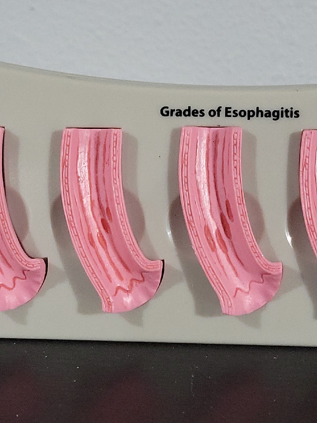 Vtg Prevacid Lansoprazole Doctor Pharmaceutical Display Grades Of Esophagitis