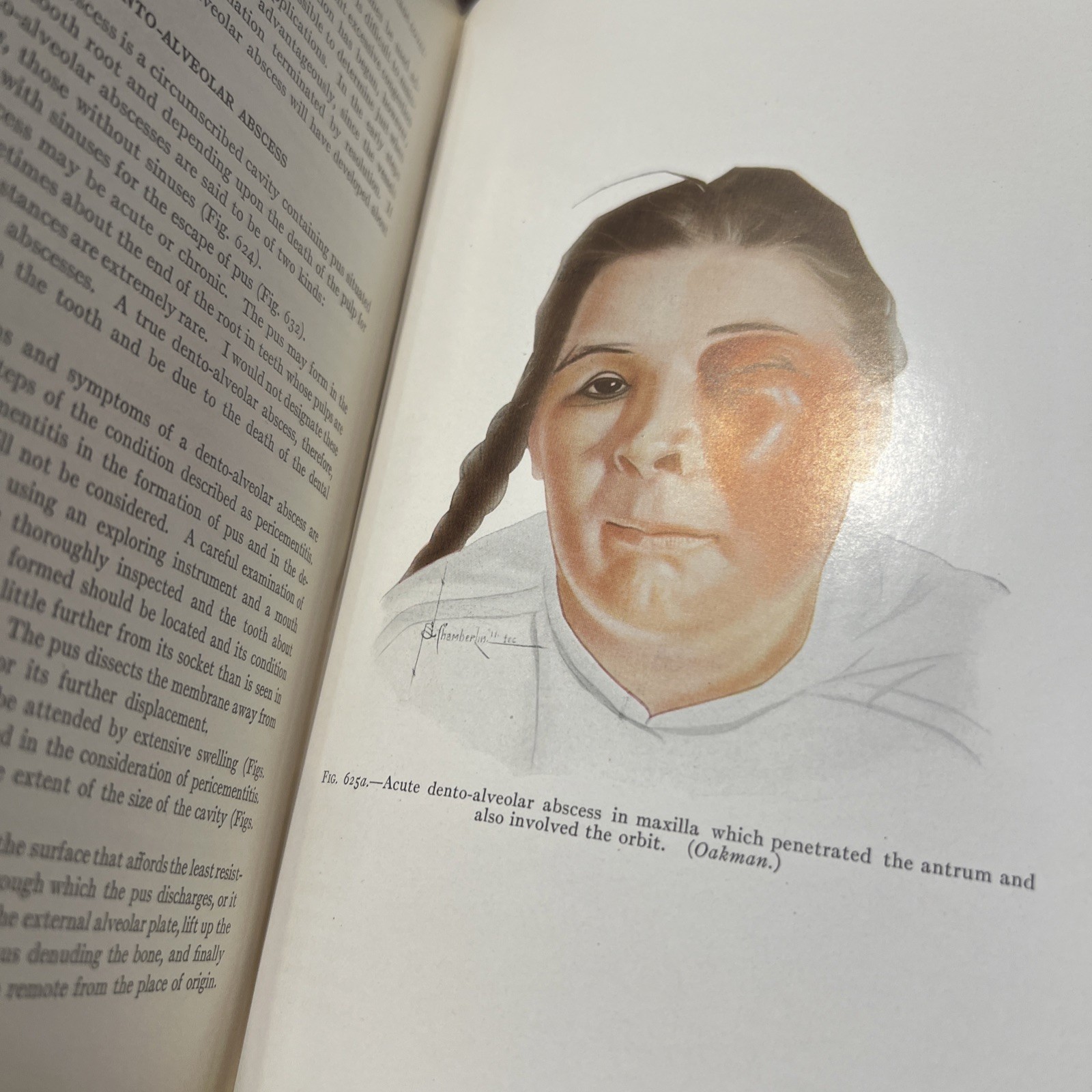 RARE Oral Surgery 1915 Illustrated Medical Dentistry Disease Truman W Brophy