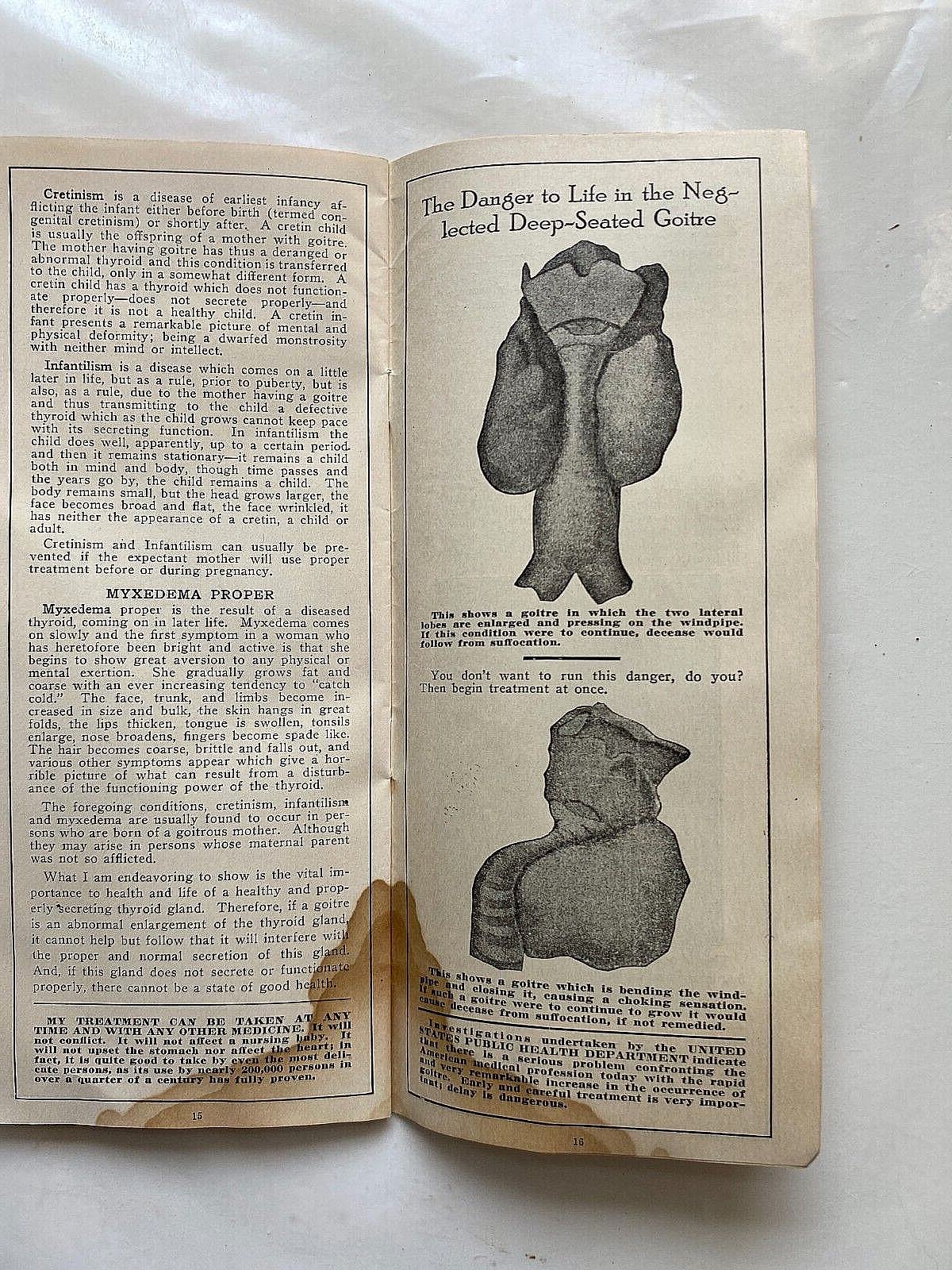 1932 Sales Literature for Goitre Cure. Dr. Arthur Rock, Milwaukee, Wisconsin.