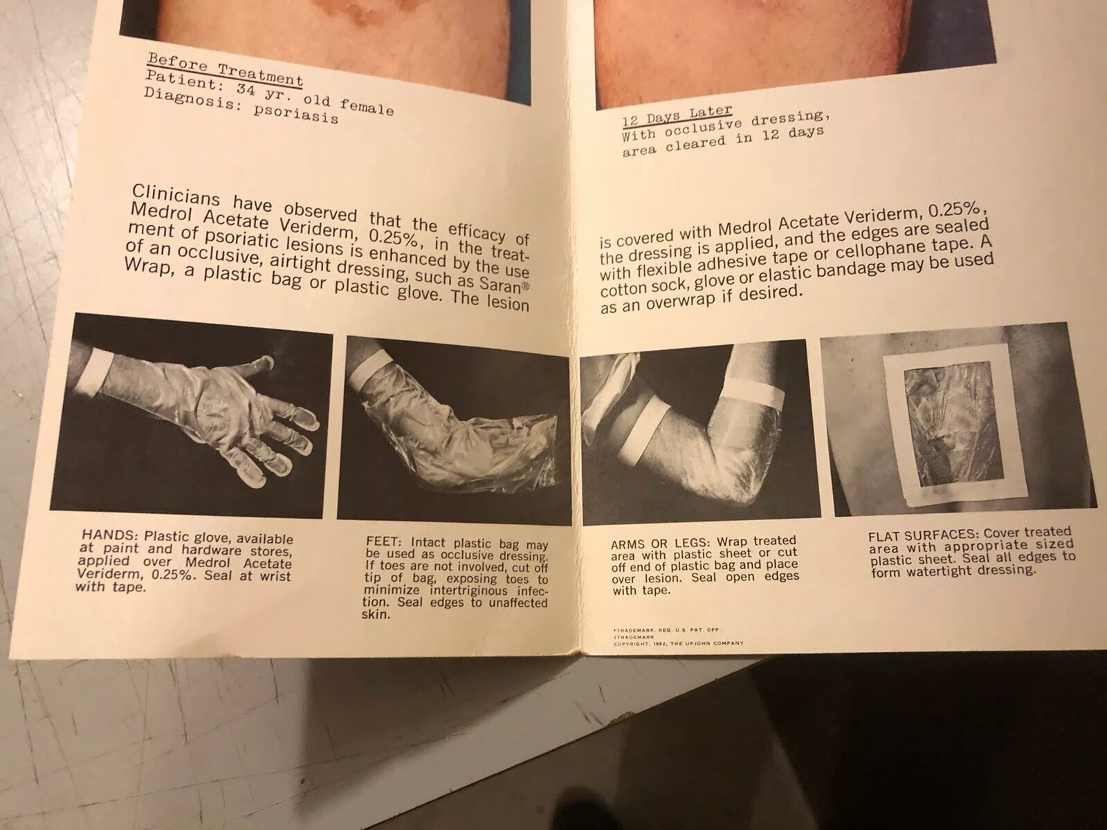 Dermatology Brochure Psoriasis Medrol Veriderm Upjohn Skin Atopic