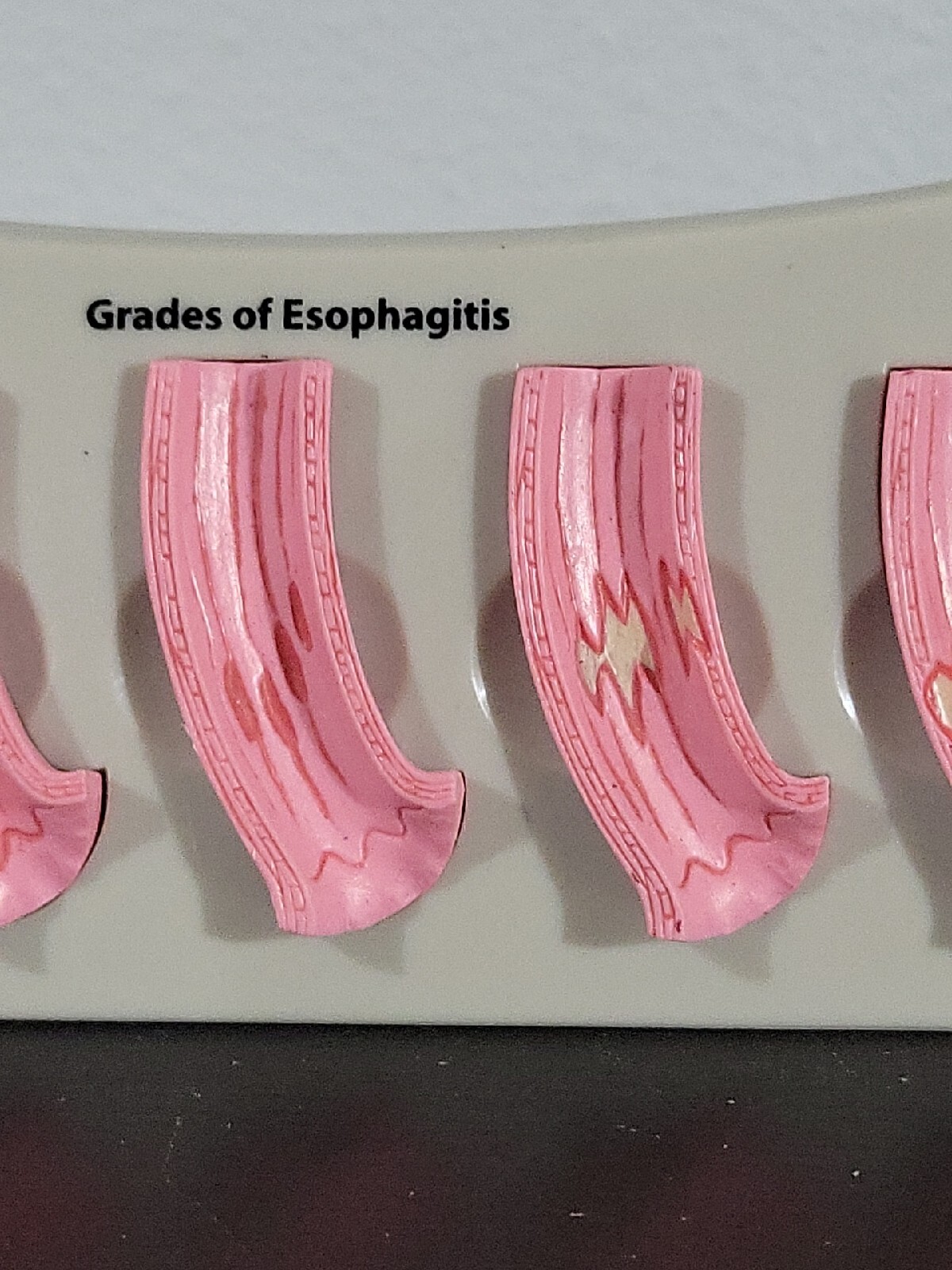 Vtg Prevacid Lansoprazole Doctor Pharmaceutical Display Grades Of Esophagitis