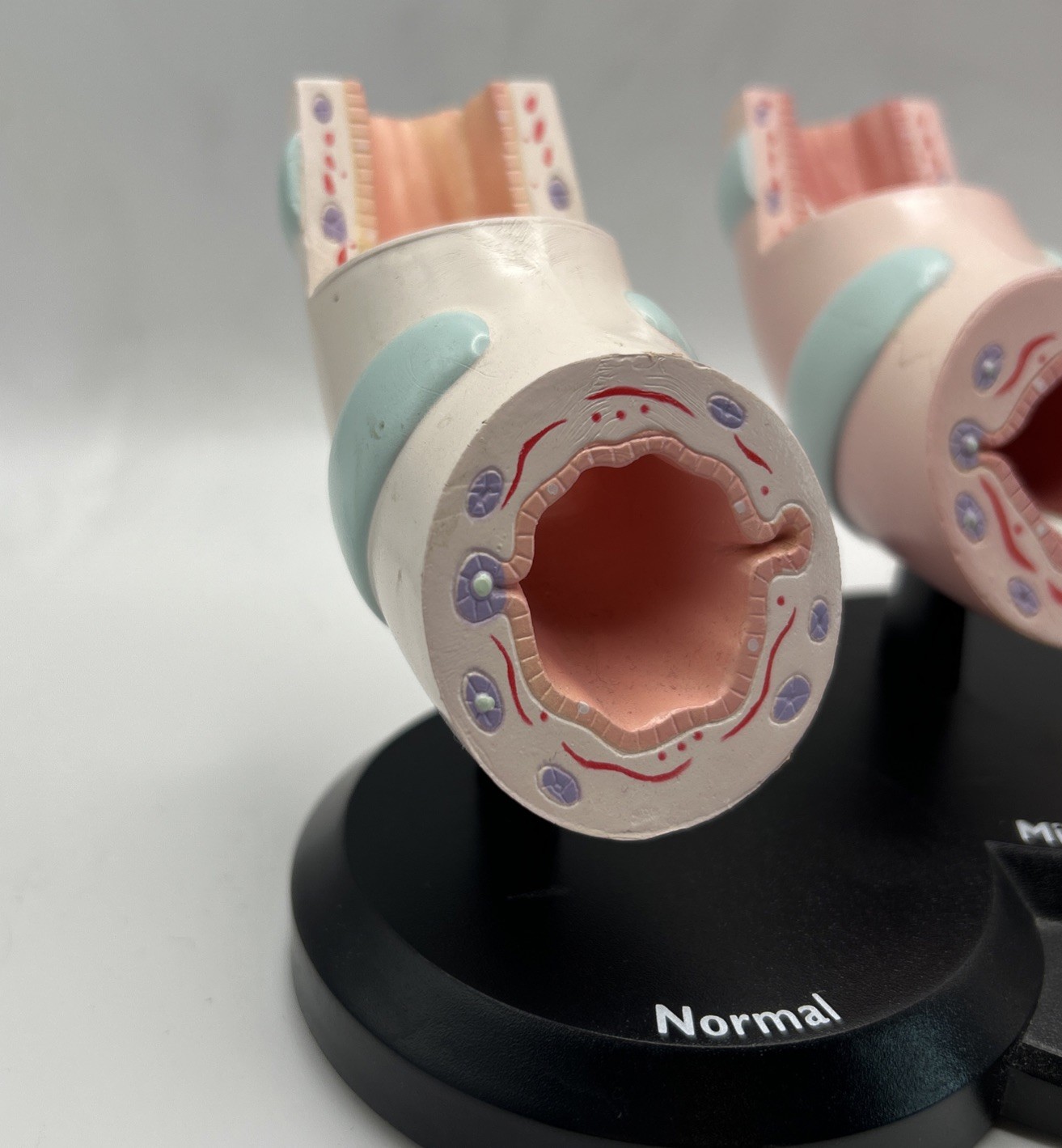 Flovent Asthma Trachea Bronchus Anatomical Pathology Model Pharmadesign 1999