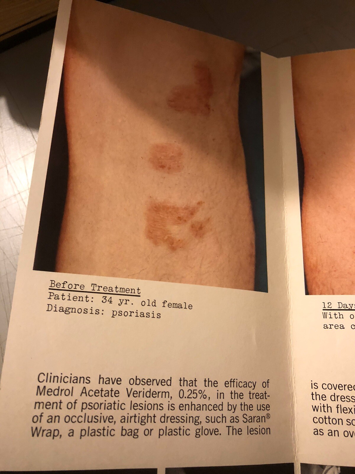 Dermatology Brochure Psoriasis Medrol Veriderm Upjohn Skin Atopic
