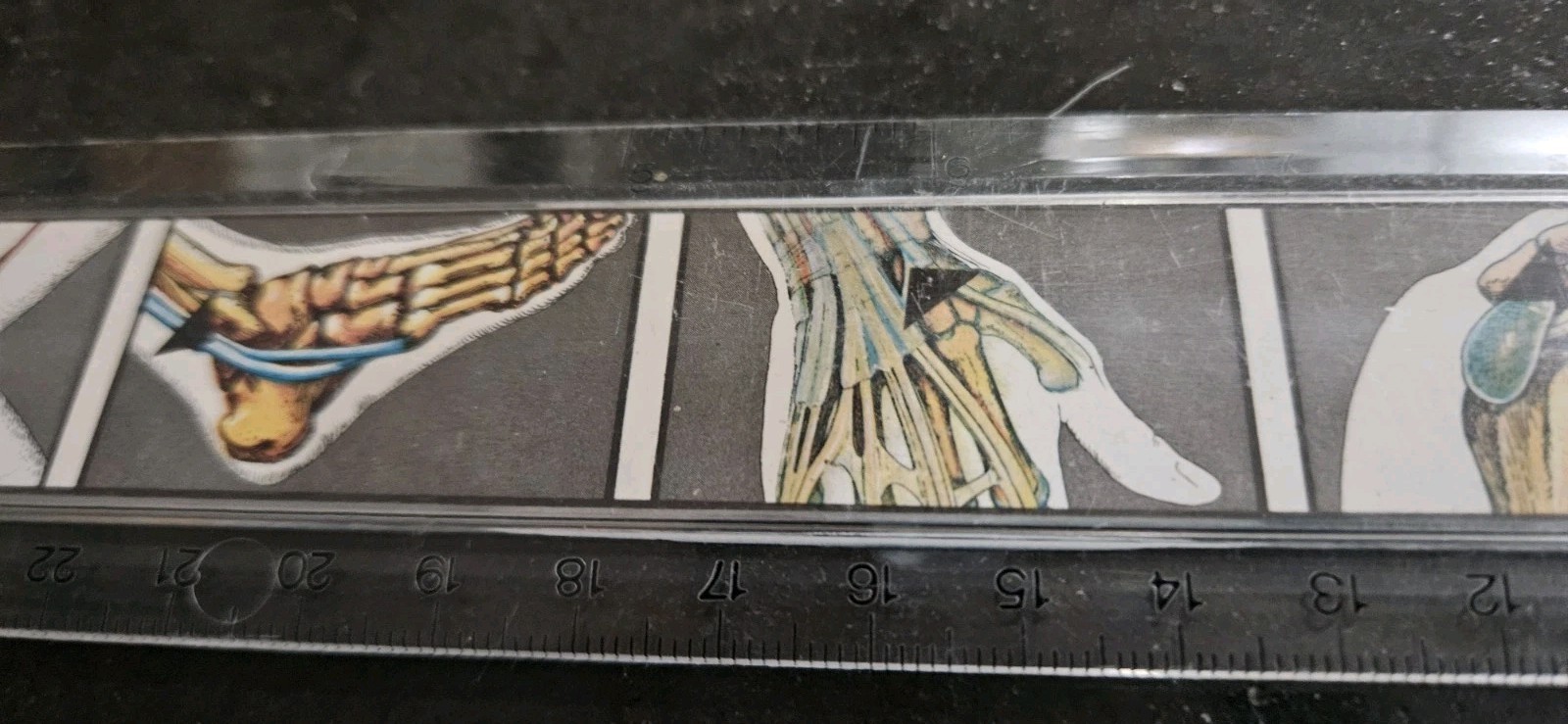 Vintage Upjohn Pharma. 12″ Plastic Ruler Advertising Lidocaine. Crawley UK