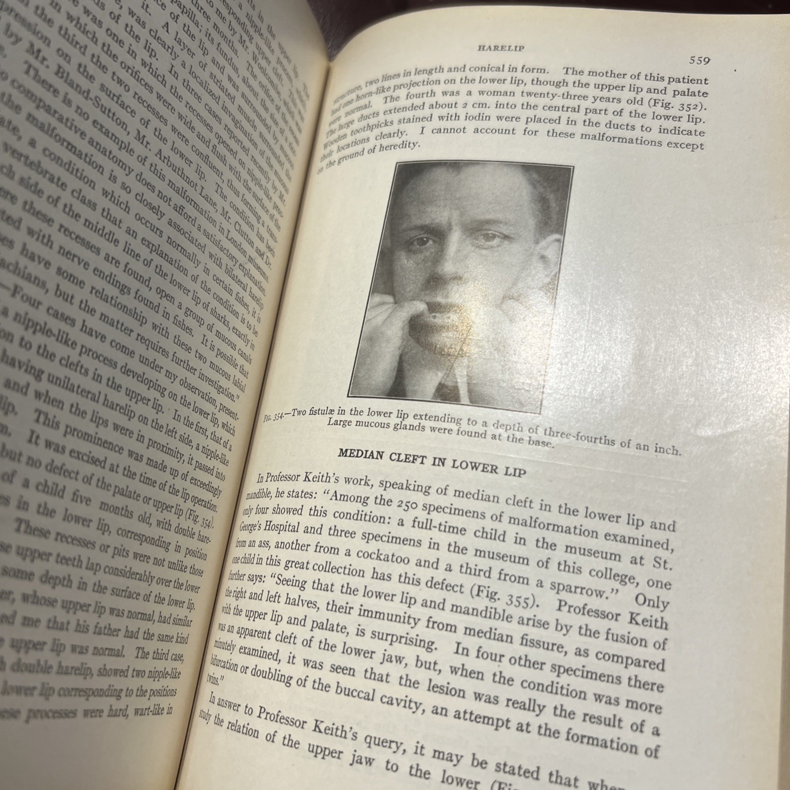 RARE Oral Surgery 1915 Illustrated Medical Dentistry Disease Truman W Brophy