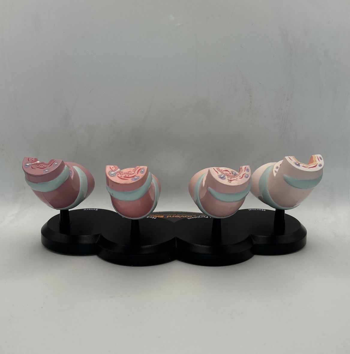 Flovent Asthma Trachea Bronchus Anatomical Pathology Model Pharmadesign 1999